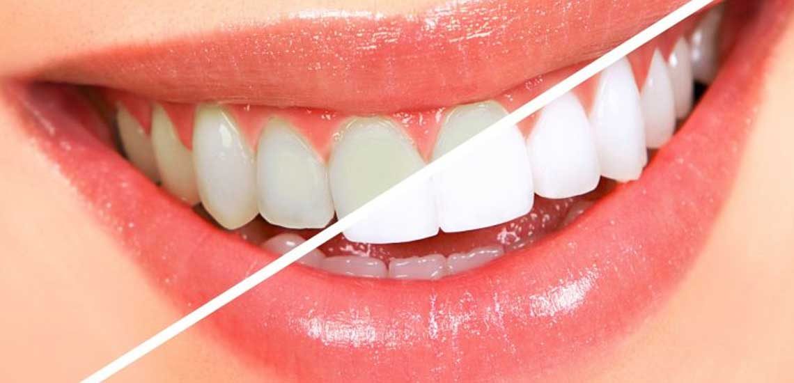https://vedental.cl/wp-content/uploads/2019/02/VE-Estetica-Dental-G-1140x550.jpg
