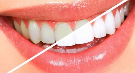 https://vedental.cl/wp-content/uploads/2019/02/VE-Estetica-Dental-G-570x310.jpg