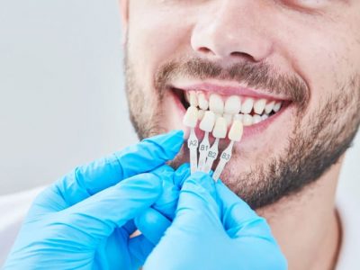 carillas-dentales-dentistas